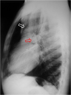 En la radiografía lateral de tórax puede verse la arteria pulmonar (flecha roja) rodeada de aire. También puede verse aire delimitando la raíz aórtica (flecha blanca).