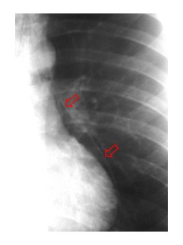 Las flechas señalan la pleura despegada del mediastino.