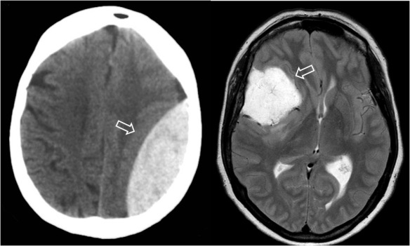 Dos ejemplos de este signo. A la izquierda, una imagen de TC con un hematoma epidural. A la derecha una RM con un meningioma.