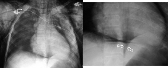 Radiografía AP de tórax en un paciente con traumatismo torácico. A la derecha las flechas marcan el signo de la V de Naclerio.