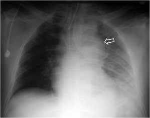 alteracion cont aorta