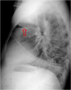 ausencia pared superior2