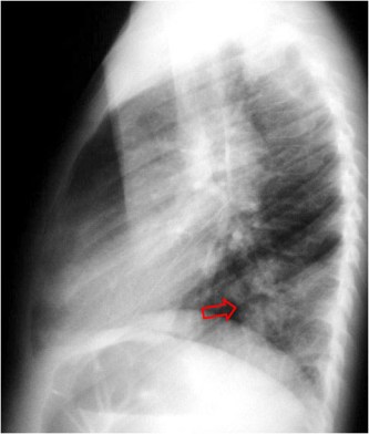 densificacion vertebral