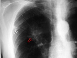 cola pleural
