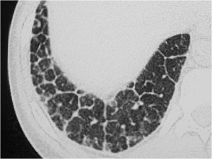diafragma en rayos de sol2