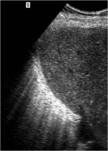 diafragma en rayos de sol3