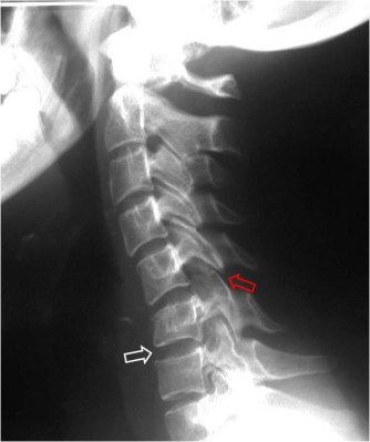 espacio discal ancho