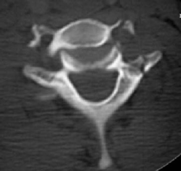 VERTEBRA DOBLE