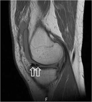 DOBLE CUERNO ANTERIOR