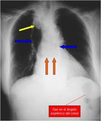 ausencia camara gaastrica