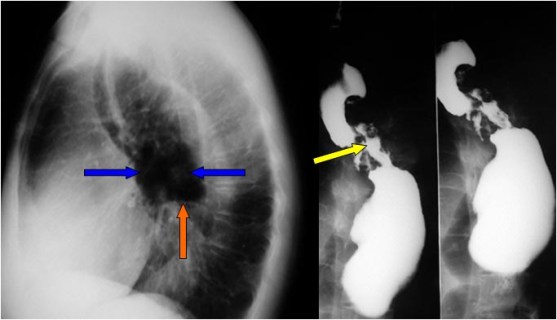 ausencia camara gaastrica2