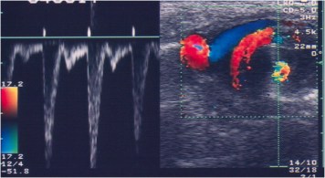 remolino en sentido horario